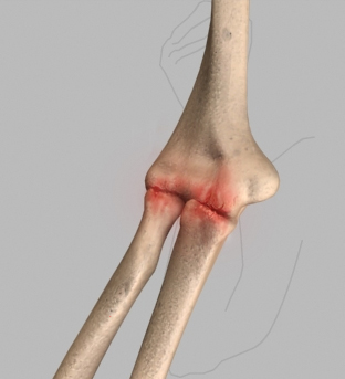 Arthritis of the Shoulder 3d imgae