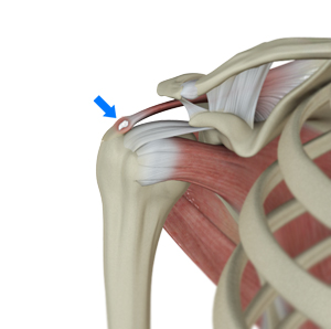 Calcific Tendinitis 3d imgae