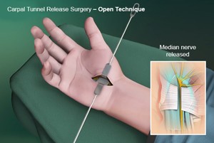 Shoulder Arthroscopy 3d imgae