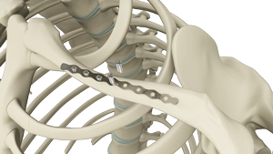 Clavicle Fracture Fixation 3d imgae