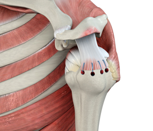 Rotator Cuff Repair and Reconstruction 3d imgae