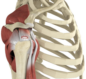 Rotator Cuff Tear 3d imgae