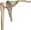 Arthritis of the Shoulder