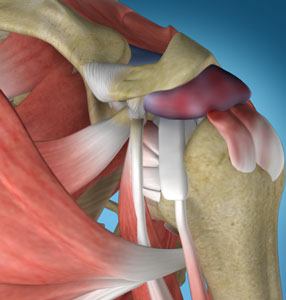 Shoulder Impingement 3d imgae