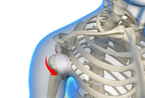 Shoulder Dislocation 3d imgae