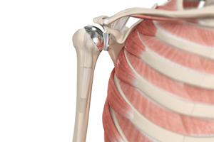 Shoulder Joint Replacement 3d imgae
