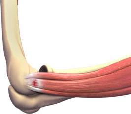 Tennis Elbow 3d imgae