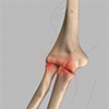 Arthritis of the Elbow