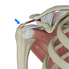 Calcific Tendinitis