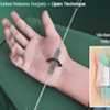 Carpal Tunnel Release