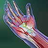 Carpal Tunnel Syndrome