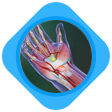 Carpal Tunnel Syndrome Image