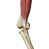 Distal Biceps Repair